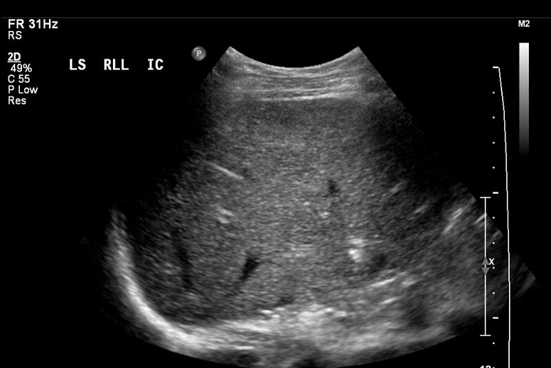 File:Biliary necrosis - liver transplant (Radiopaedia 21876-21843 A 3).jpg