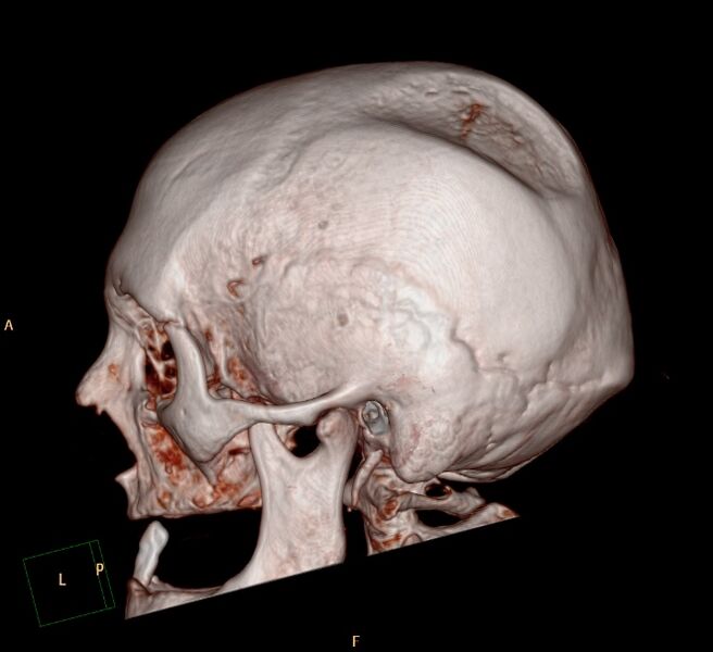 File:Biparietal osteodystrophy (Radiopaedia 46109-50463 3D 3D VR 3).jpg