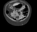 Bladder papillary urothelial carcinoma (Radiopaedia 48119-52951 C 11).png