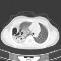 Bochdalek diaphragmatic hernia (Radiopaedia 38866-41059 Axial lung window 7).jpg