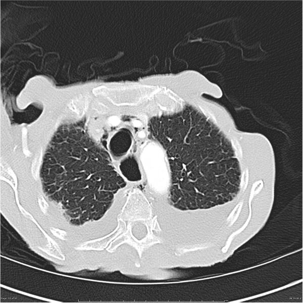 File:Boerhaave syndrome (Radiopaedia 26240-26362 Axial lung window 11).jpg