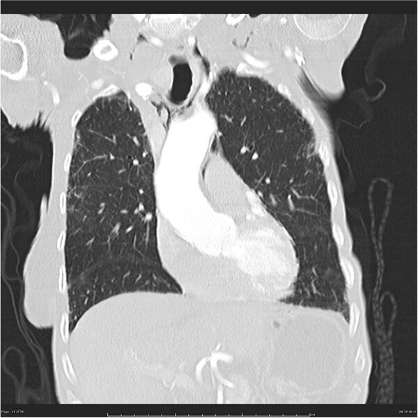 File:Boerhaave syndrome (Radiopaedia 26240-26362 Coronal lung window 11).jpg