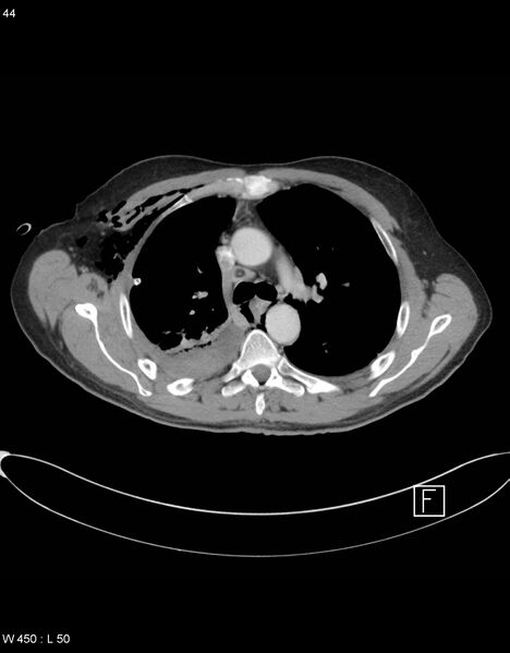 File:Boerhaave syndrome with tension pneumothorax (Radiopaedia 56794-63605 A 21).jpg