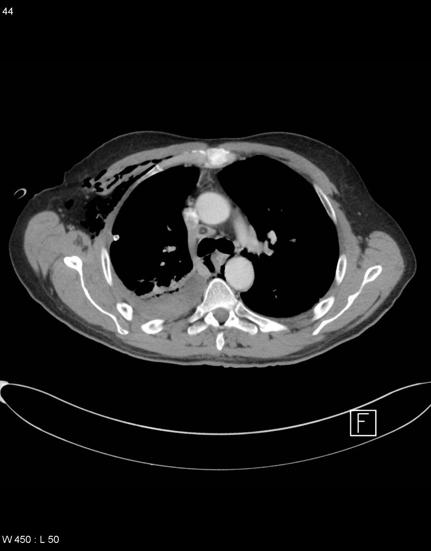 Boerhaave syndrome with tension pneumothorax (Radiopaedia 56794-63605 A 21).jpg