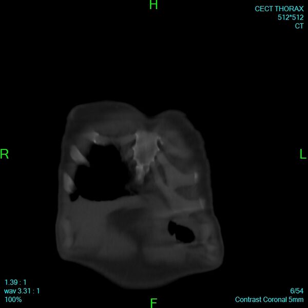 File:Bone metastases from lung carcinoma (Radiopaedia 54703-60937 Coronal bone window 6).jpg
