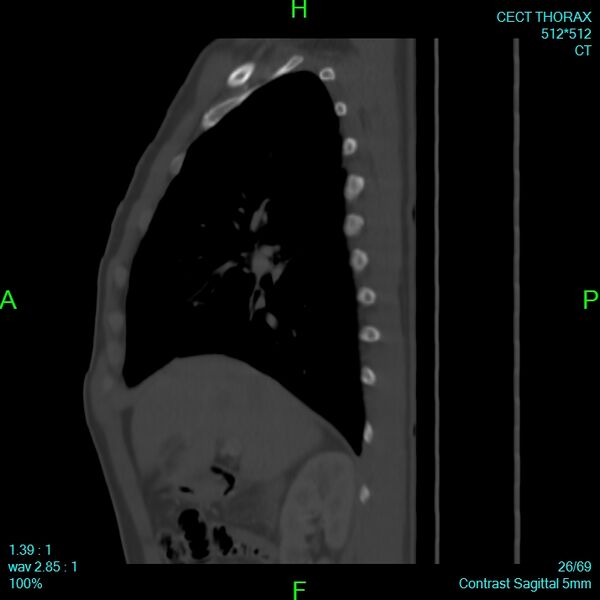 File:Bone metastases from lung carcinoma (Radiopaedia 54703-60937 Sagittal bone window 26).jpg