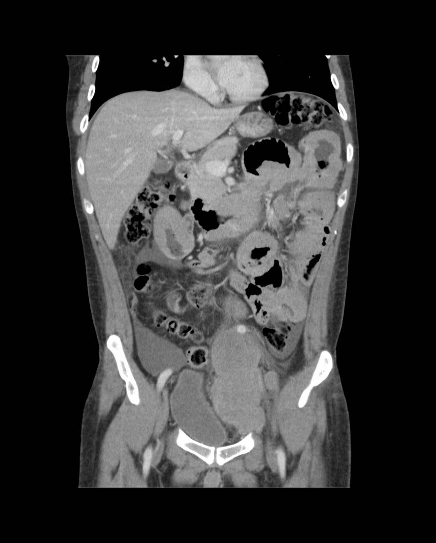 Bowel lymphoma complicated by bleeding after therapy (Radiopaedia 55601-62107 B 29).jpg