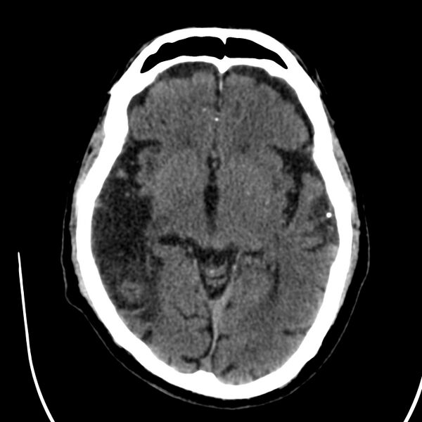 File:Brain Pantopaque remnants (Radiopaedia 78403-91048 Axial non-contrast 47).jpg