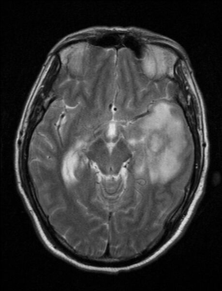File:Brain abscess with ventriculitis (Radiopaedia 85703-101495 Axial T2 11).jpg