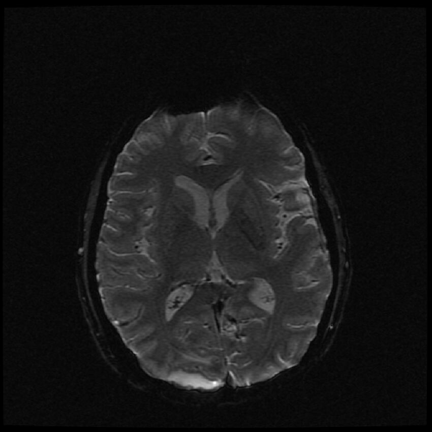 Brain metastases (renal cell carcinoma) (Radiopaedia 42571-45704 Axial SWI 29).jpg