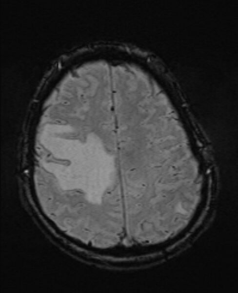 File:Brain metastases - lung cancer primary (Radiopaedia 75060-86115 Axial SWI 47).jpg