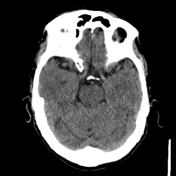 File:Brain metastases from lung cancer (Radiopaedia 27849-28092 Axial non-contrast 17).jpg