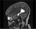 Brainstem glioma (Radiopaedia 21819-21775 Sagittal T2 21).jpg