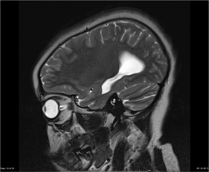 File:Brainstem glioma (Radiopaedia 21819-21775 Sagittal T2 21).jpg