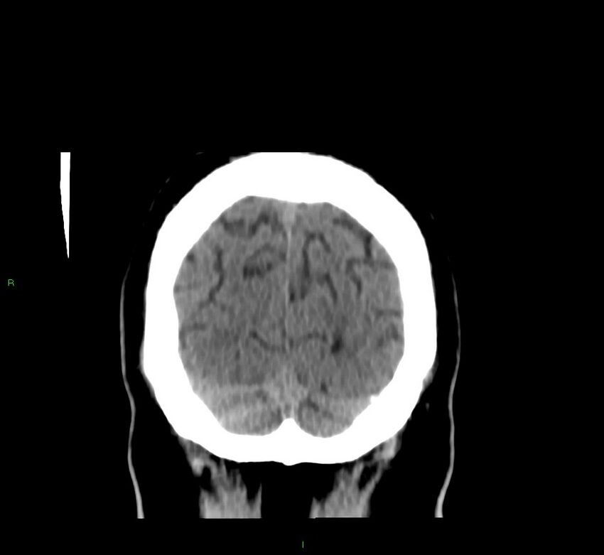 Brainstem hemorrhage (Radiopaedia 58794-66028 Coronal non-contrast 11).jpg