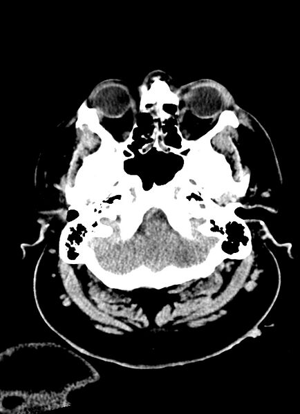 File:Brainstem hemorrhage (Radiopaedia 81294-94976 Axial non-contrast 52).jpg