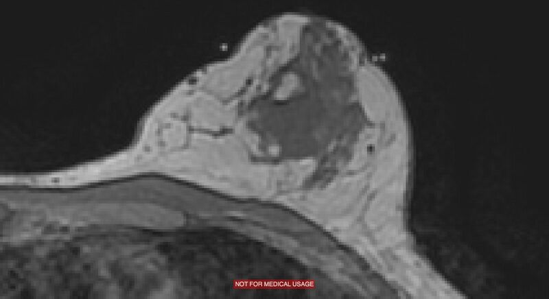File:Breast lymphoma (MRI) (Radiopaedia 34999-36498 Axial T1 1).jpg