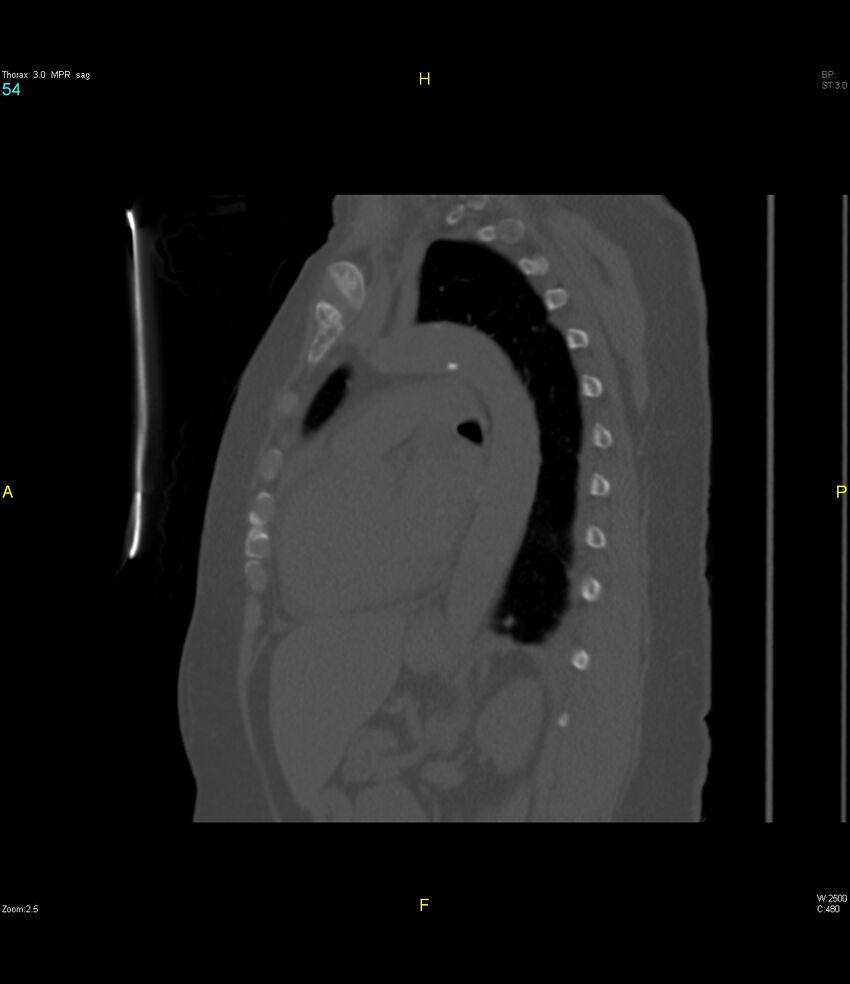 Breast primary with lung and bone metastases (Radiopaedia 40620-43228 Sagittal bone window 54).jpg