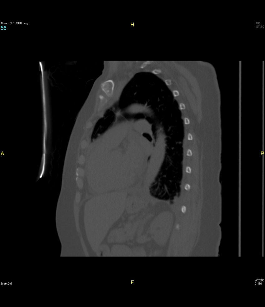Breast primary with lung and bone metastases (Radiopaedia 40620-43228 Sagittal bone window 56).jpg