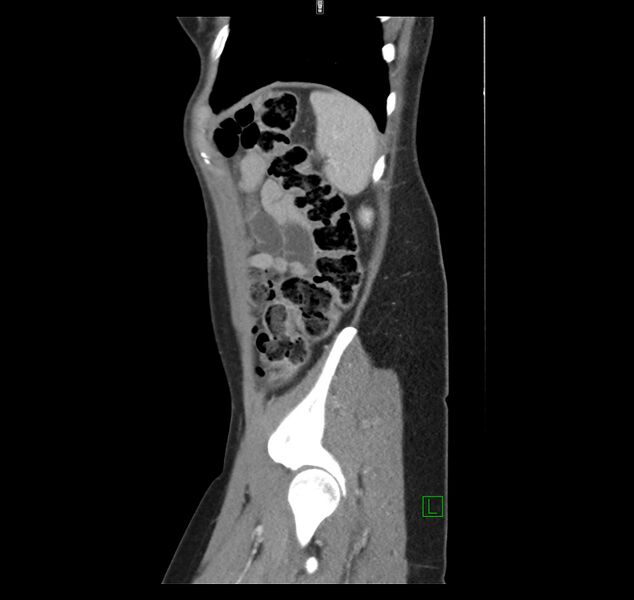 File:Broad ligament hernia (Radiopaedia 63260-71832 C 46).jpg