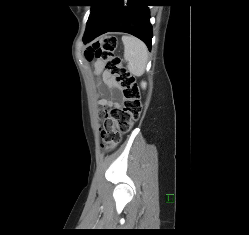 Broad ligament hernia (Radiopaedia 63260-71832 C 46).jpg
