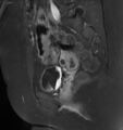 Broad ligament leiomyoma (Radiopaedia 81634-95516 G 11).jpg