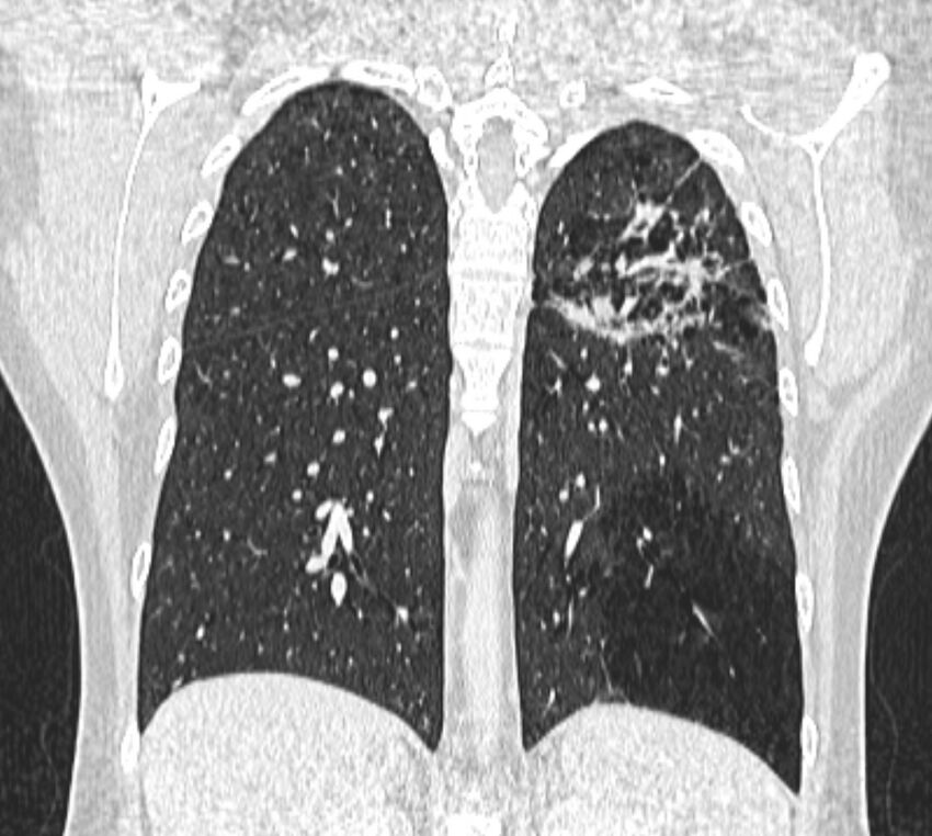 Bronchial atresia (Radiopaedia 50007-55297 Coronal lung window 82).jpg