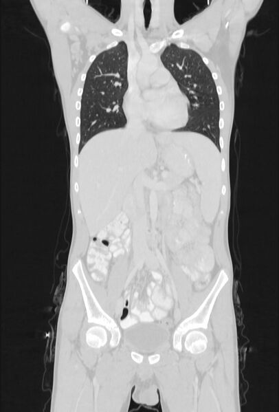 File:Bronchial carcinoid tumor (Radiopaedia 57187-64090 Coronal lung window 39).jpg