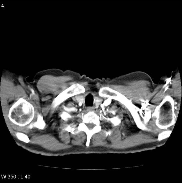 File:Bronchial carcinoid tumor with right lower lobe collapse (Radiopaedia 29060-29422 A 3).jpg
