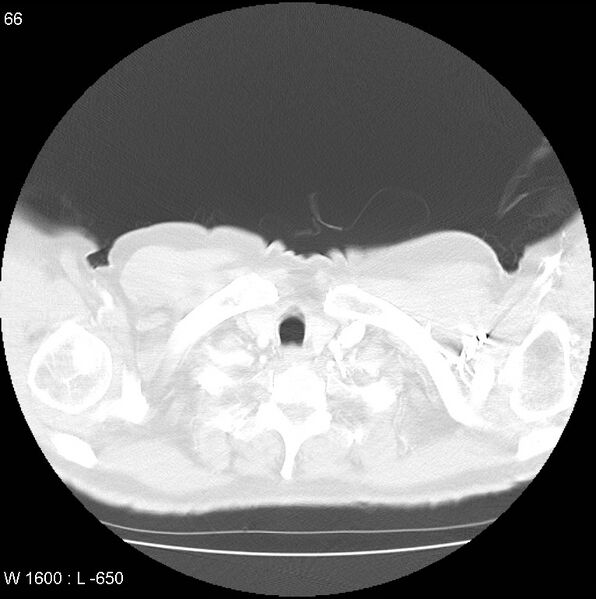 File:Bronchial carcinoid tumor with right lower lobe collapse (Radiopaedia 29060-29422 B 4).jpg
