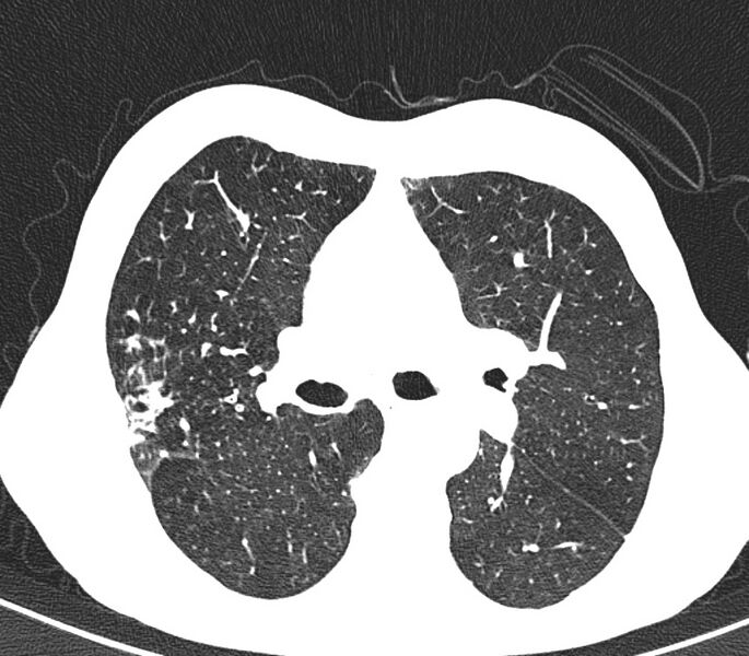 File:Bronchiolitis (Radiopaedia 24616-24887 Axial lung window 23).jpg