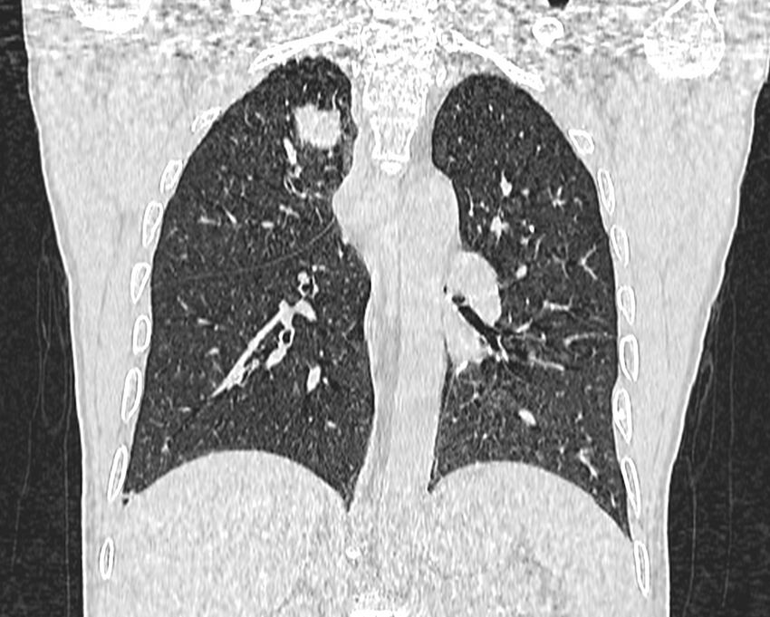 Bronchogenic carcinoma with superior vena cava syndrome (Radiopaedia 36497-38054 Coronal lung window 62).jpg