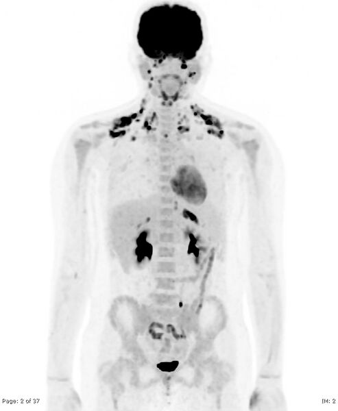 File:Brown fat uptake (FDG PET-CT) (Radiopaedia 77392-89513 MIP 1).jpg