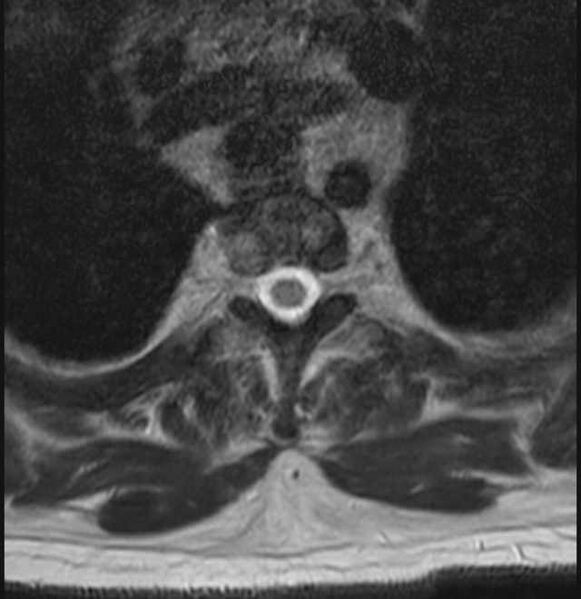 File:Brown tumors compressing the spinal cord (Radiopaedia 68442-78030 A 47).jpg