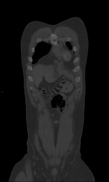 File:Burst fracture (Radiopaedia 83168-97542 Coronal bone window 15).jpg