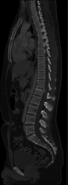 File:Burst fracture (Radiopaedia 83168-97542 Sagittal bone window 69).jpg