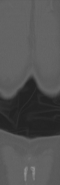 File:Burst fracture - T12 with conus compression (Radiopaedia 56825-63647 Coronal bone window 42).png