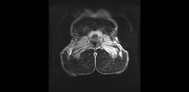 File:Buttock filler complications (Radiopaedia 63497-72115 Coronal T1 C+ 57).jpg