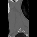 C5 facet fracture (Radiopaedia 58374-65499 Sagittal bone window 13).jpg