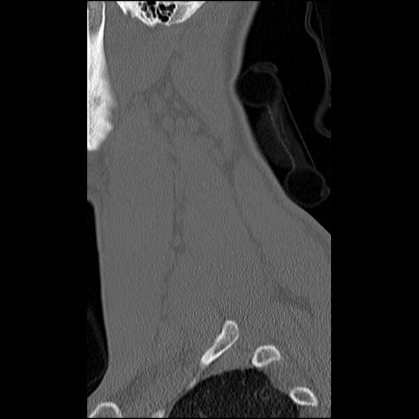 File:C5 facet fracture (Radiopaedia 58374-65499 Sagittal bone window 13).jpg