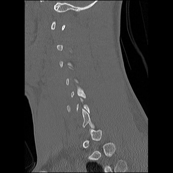 File:C5 facet fracture (Radiopaedia 58374-65499 Sagittal bone window 24).jpg