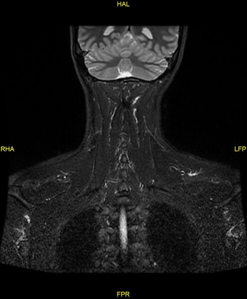 File:C5 nerve sheath tumor (Radiopaedia 85777-101596 Coronal T2 fat sat 18).jpg