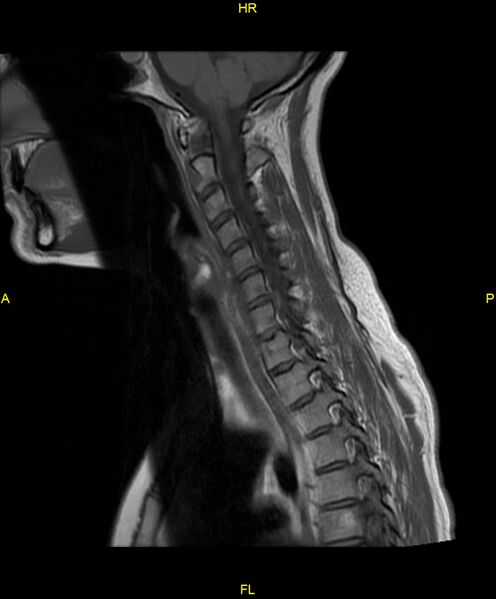 File:C5 nerve sheath tumor (Radiopaedia 85777-101596 Sagittal T1 12).jpg