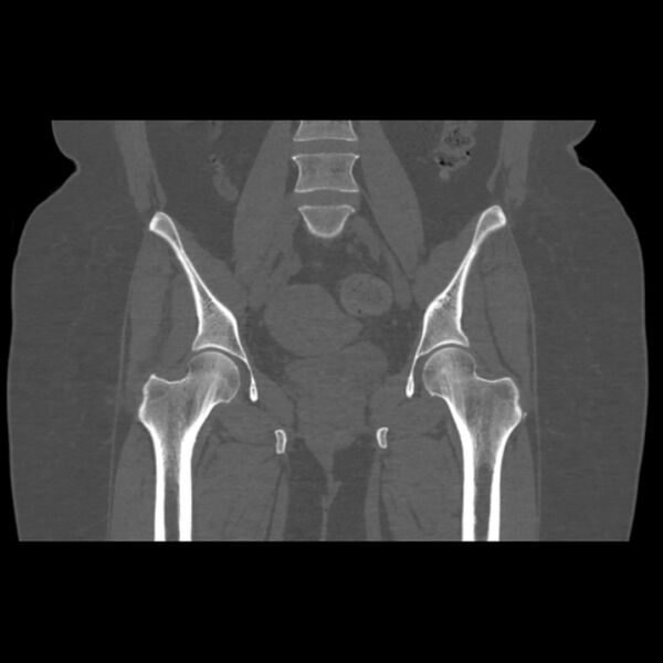 File:Calcific tendinitis of the gluteus medius muscle (Radiopaedia 66998-76318 Coronal bone window 29).jpg