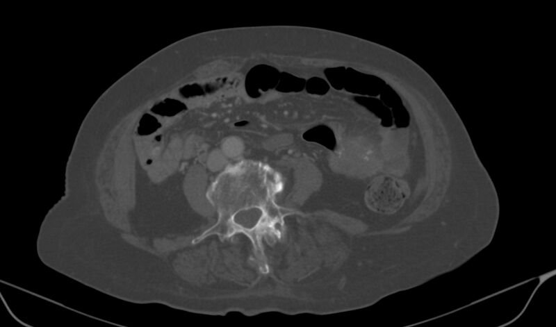 File:Calcified fibroids (Radiopaedia 20306-20228 Axial bone window 1).jpg