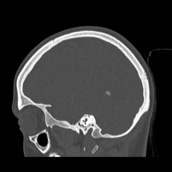 File:Calvarial osteoma (Radiopaedia 36520-38079 Sagittal bone window 76).jpg