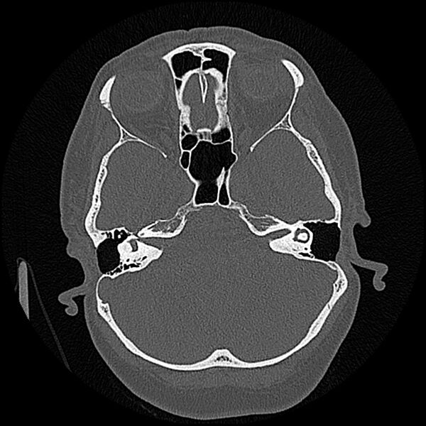 File:Canal up mastoidectomy (Radiopaedia 78108-90638 Axial bone window 84).jpg