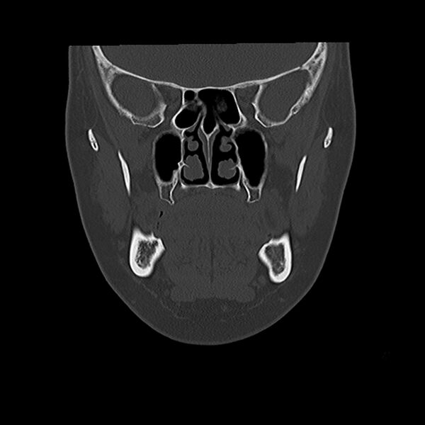 File:Canal up mastoidectomy (Radiopaedia 78108-90638 Coronal bone window 14).jpg