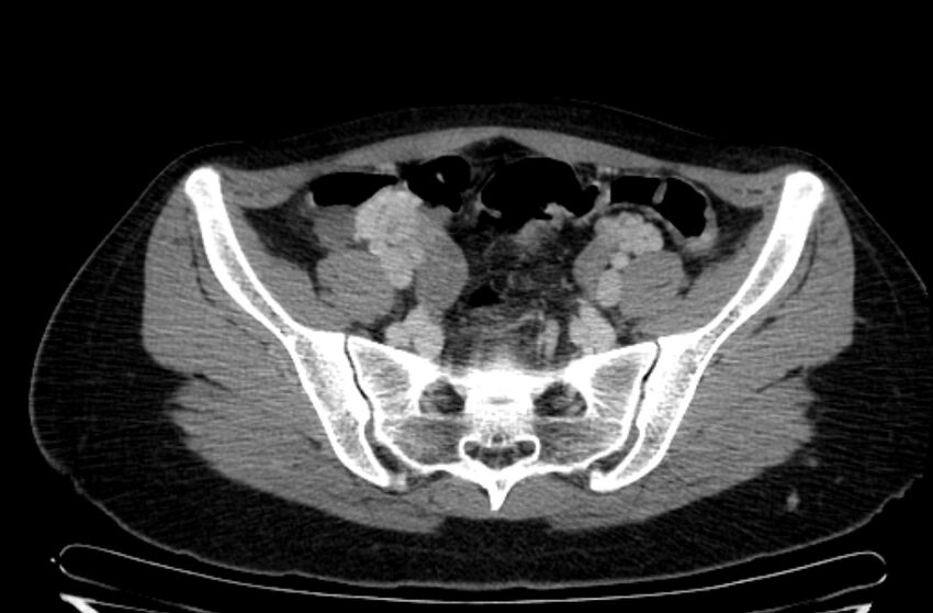 Cannonball metastases - uterine choriocarcinoma (Radiopaedia 70137-80174 A 5).jpg