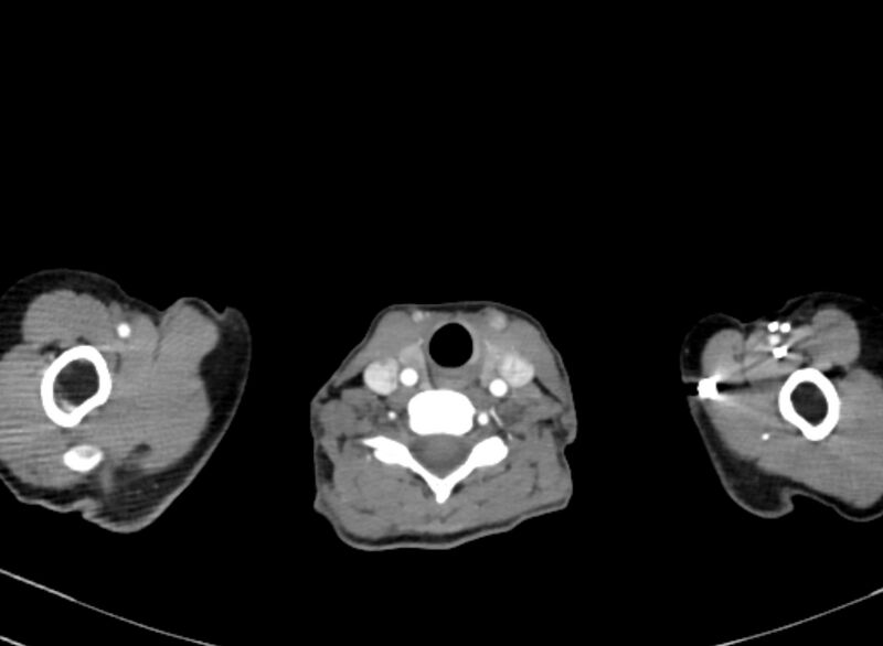 File:Cannonball metastases from breast cancer (Radiopaedia 91024-108569 A 1).jpg